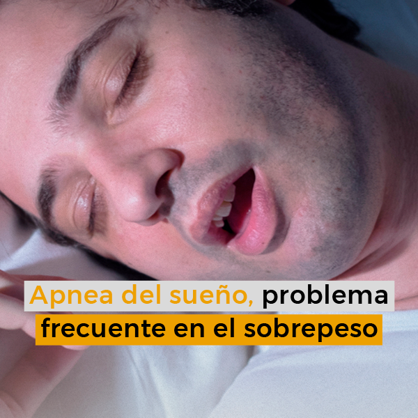 Apnea del sueño, problema frecuente en el sobrepeso 